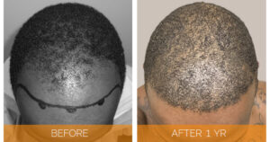 Hair-Transplants