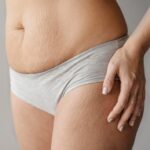 Remove-White-Stretch-Marks