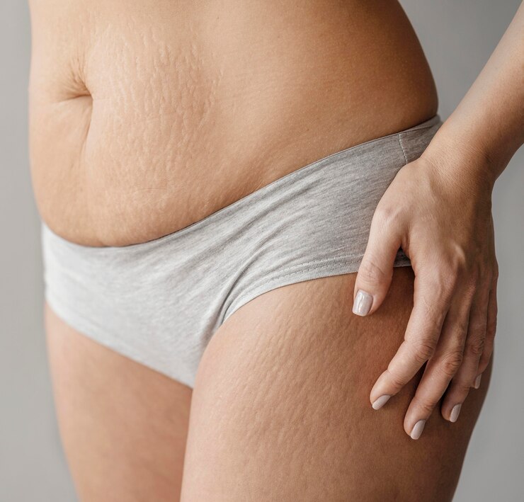 Remove-White-Stretch-Marks