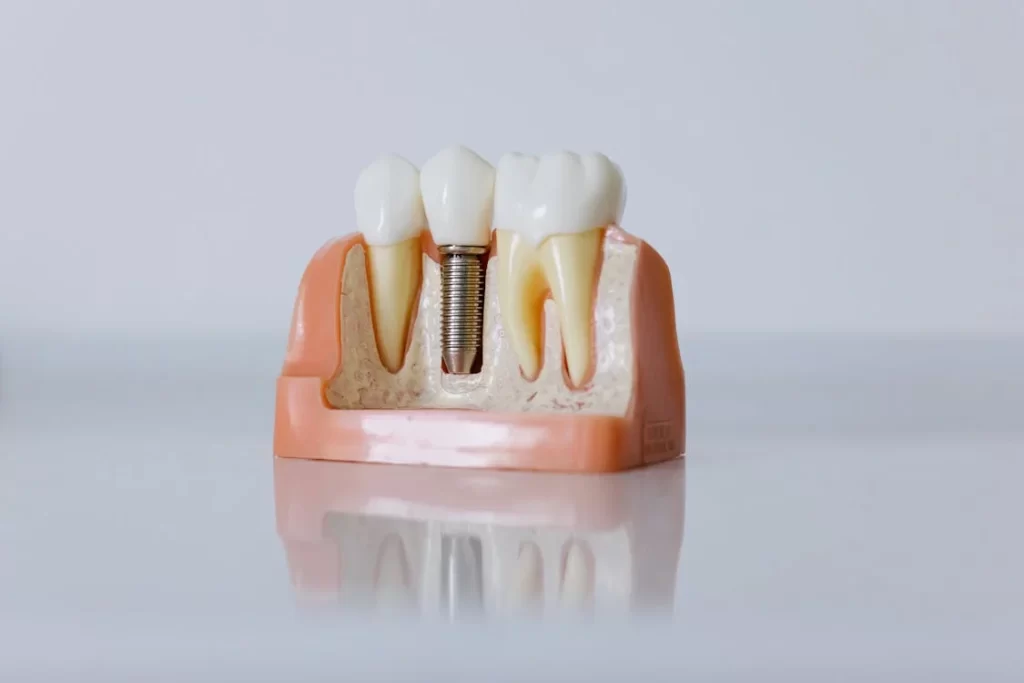 dental-implant