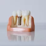 dental-implant