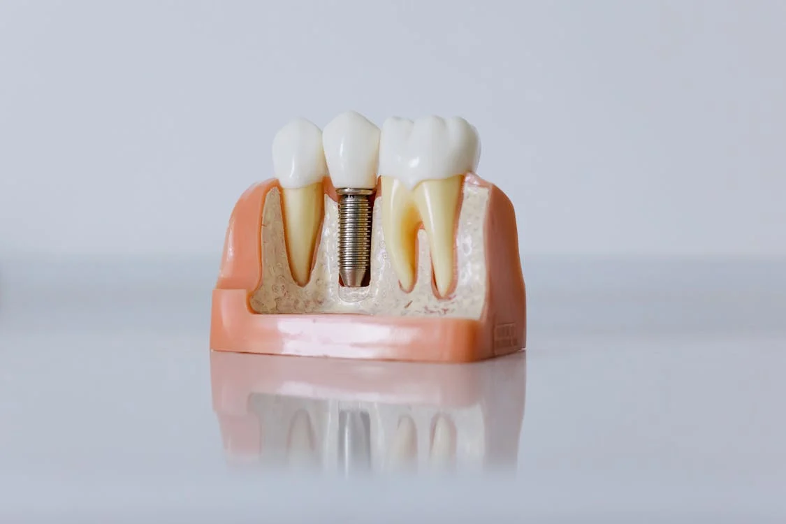 dental-implant